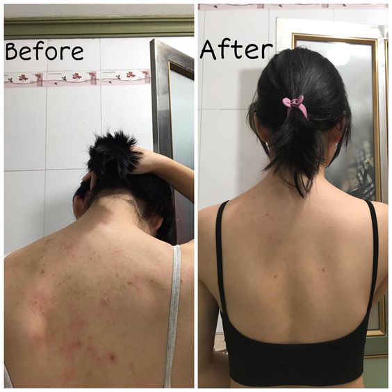 nguyên nhân bị mụn lưng và cách điều trị