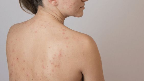 Phương pháp đề xử lý mụn lưng không tái đi tái lại nhiều lần: